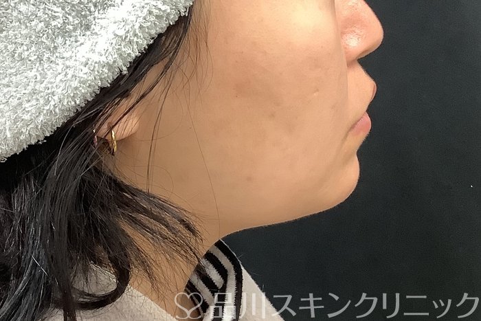 症例NO.69513のAFTER写真