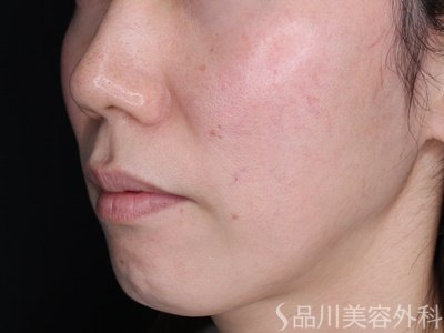 症例NO.69562のBEFORE写真