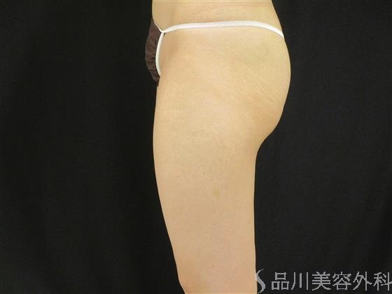 症例NO.55025のAFTER写真