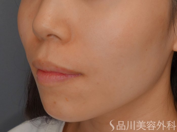 症例NO.73404のAFTER写真