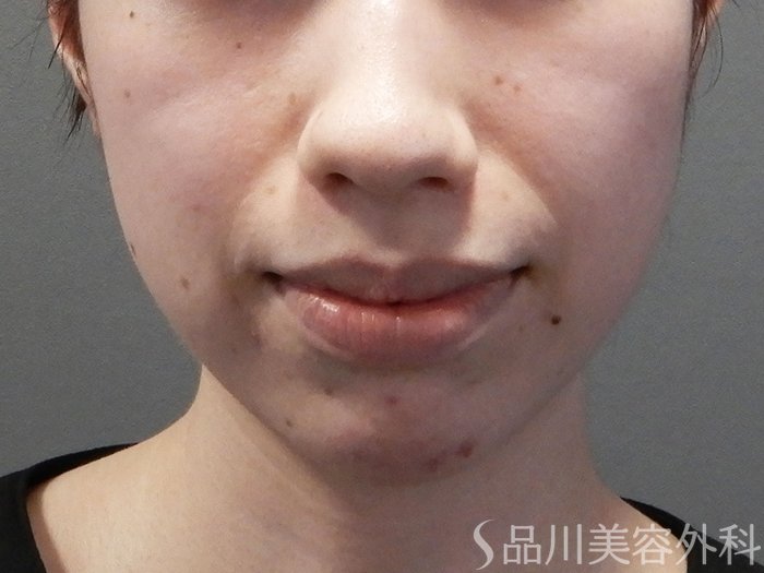 症例NO.71934のBEFORE写真