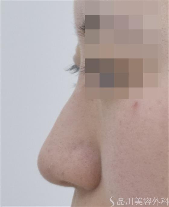 症例NO.47698のBEFORE写真