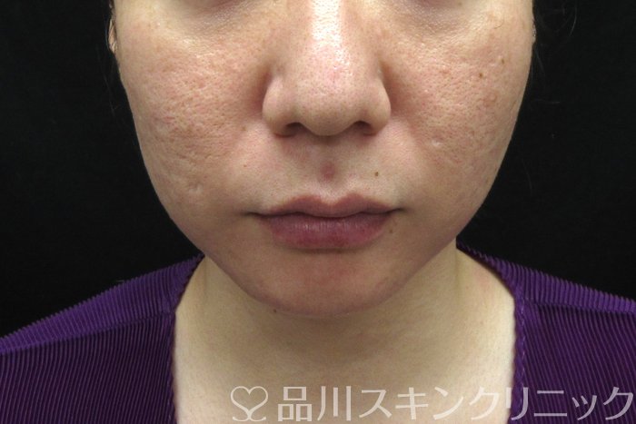症例NO.74693のBEFORE写真