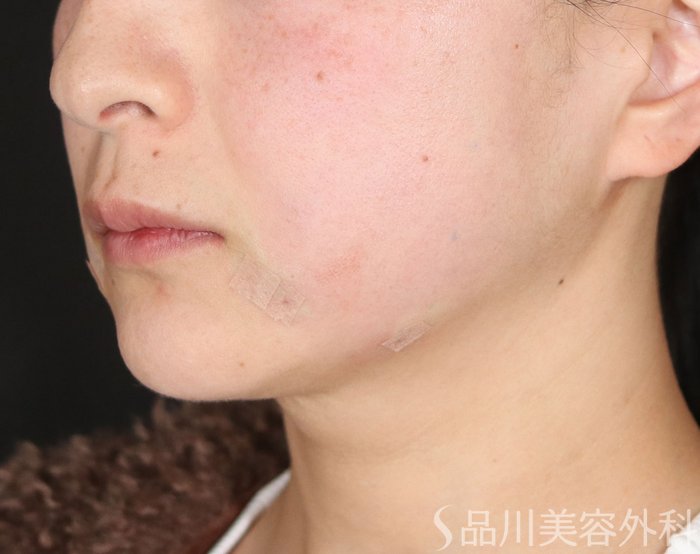 症例NO.73085のAFTER写真