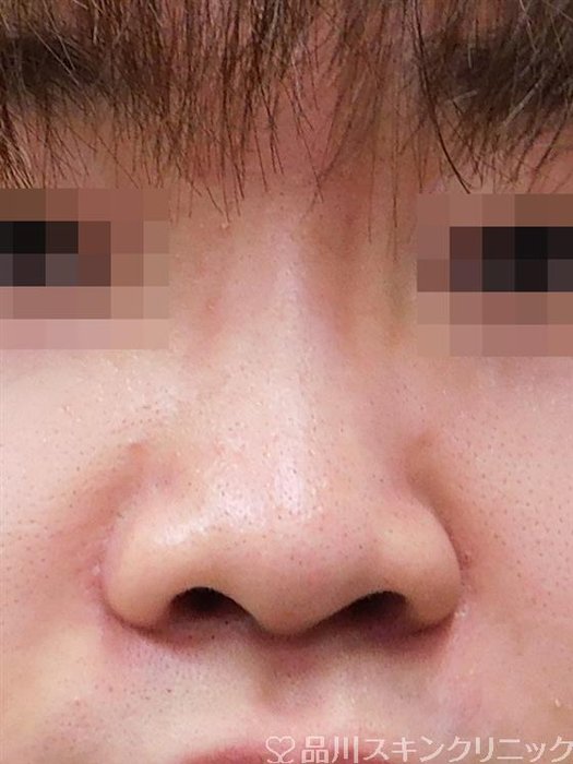 症例NO.55569のBEFORE写真