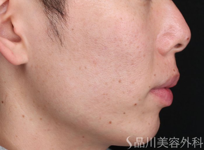 症例NO.72875のAFTER写真