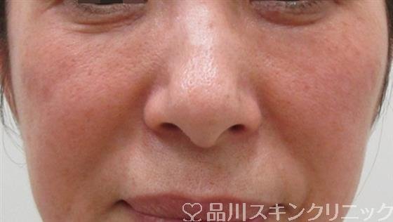 症例NO.32600のBEFORE写真