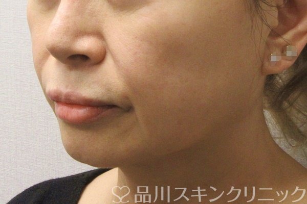 症例NO.72768のBEFORE写真