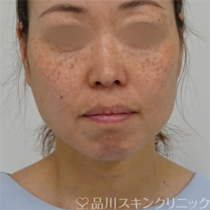症例NO.70438のBEFORE写真