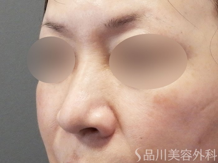 症例NO.70618のBEFORE写真