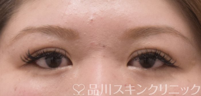 症例NO.73252のAFTER写真