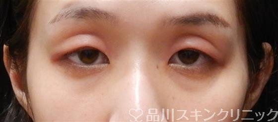 症例NO.56156のBEFORE写真