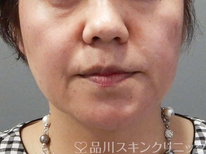 症例NO.71855のBEFORE写真