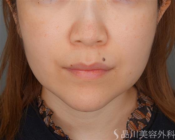 症例NO.53830のBEFORE写真