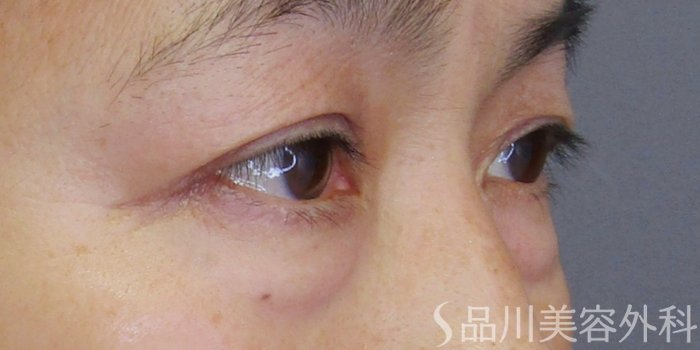 症例NO.75136のBEFORE写真