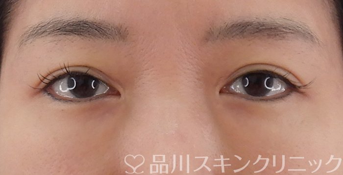 症例NO.62183のAFTER写真