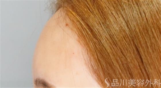 症例NO.52525のAFTER写真