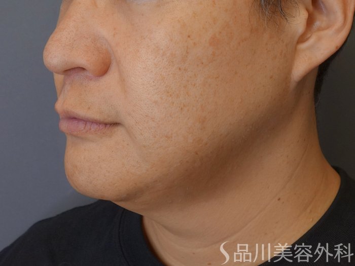 症例NO.73068のAFTER写真