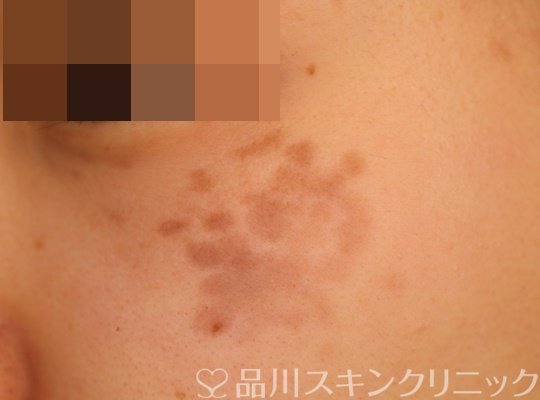 症例NO.71054のBEFORE写真