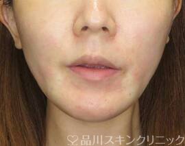 症例NO.72246のAFTER写真