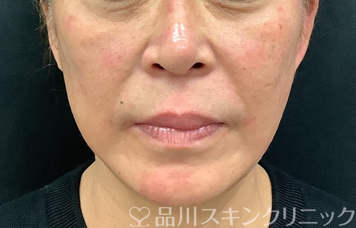 症例NO.67887のAFTER写真