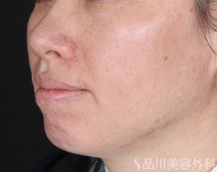 症例NO.72201のBEFORE写真