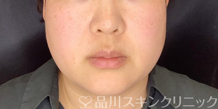 症例NO.70081のAFTER写真