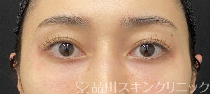 症例NO.74155のAFTER写真