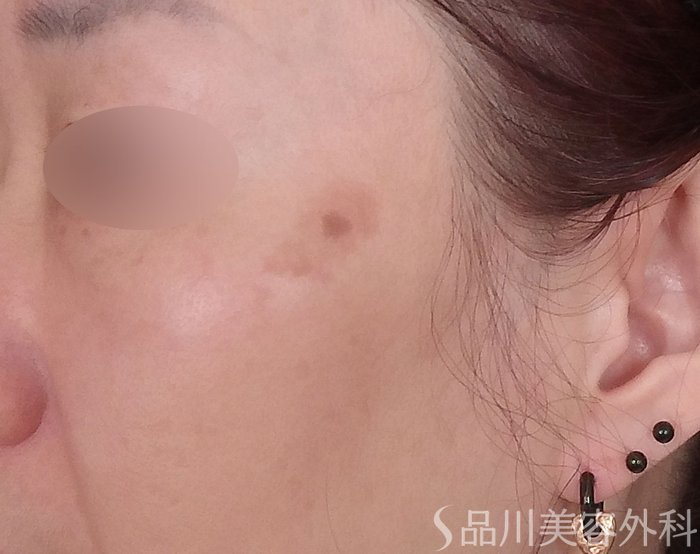 症例NO.72484のBEFORE写真