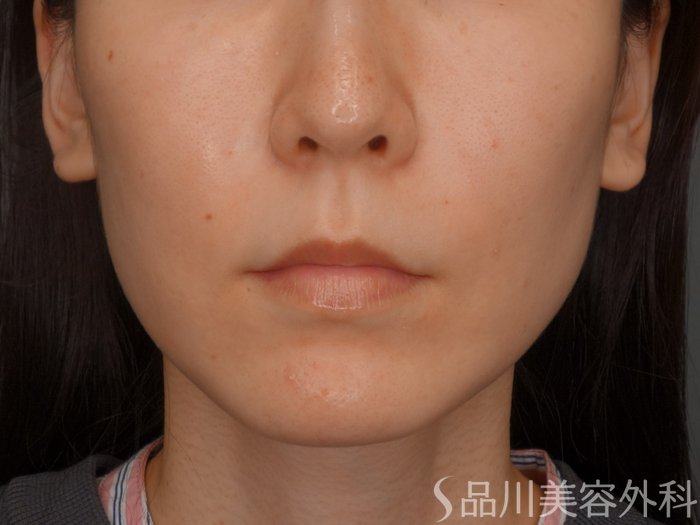 症例NO.73721のBEFORE写真