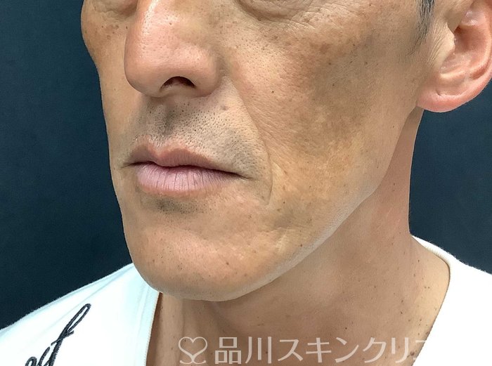 症例NO.71042のBEFORE写真