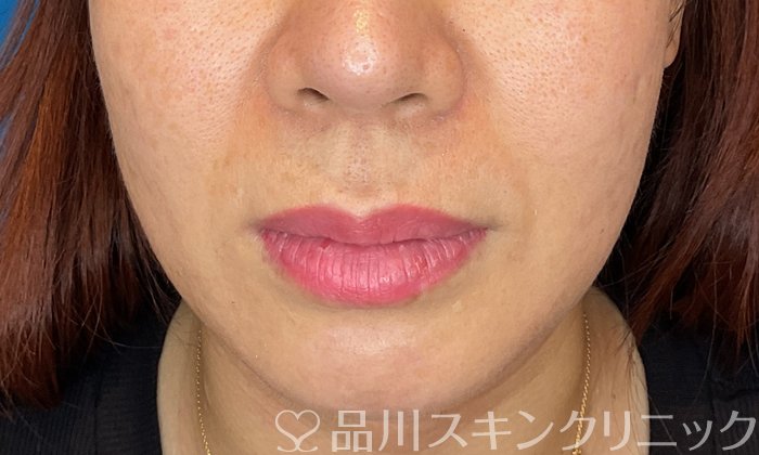 症例NO.74849のBEFORE写真