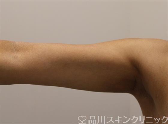 症例NO.49239のAFTER写真
