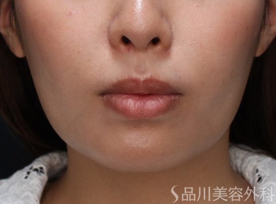 症例NO.73863のAFTER写真