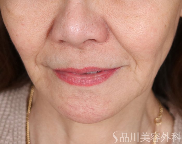 症例NO.73986のBEFORE写真
