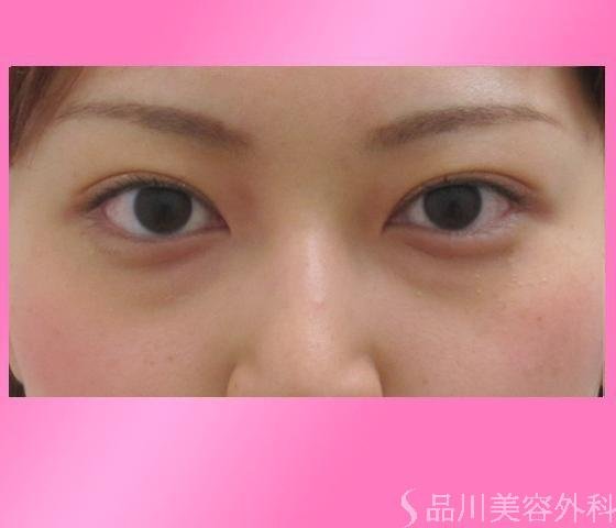 症例NO.2427のAFTER写真
