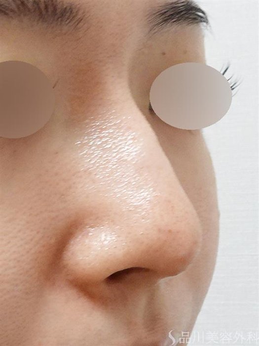 症例NO.51490のAFTER写真