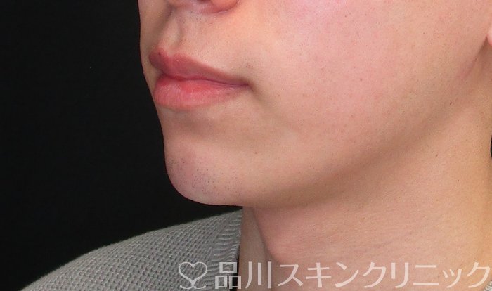 症例NO.73447のAFTER写真