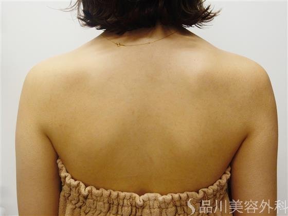 症例NO.50368のBEFORE写真