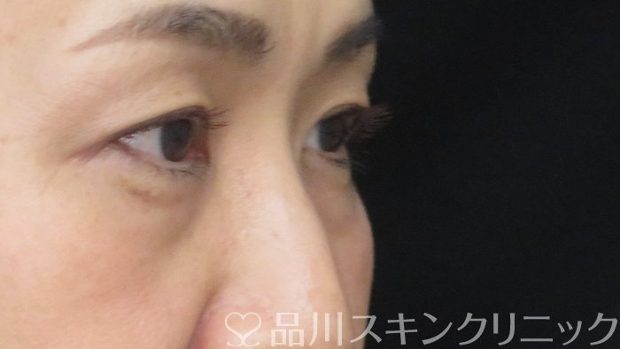 症例NO.72404のBEFORE写真