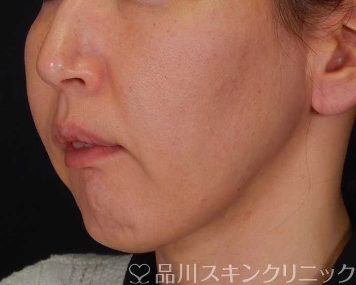 症例NO.64227のBEFORE写真