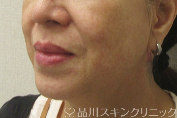 症例NO.75224のBEFORE写真