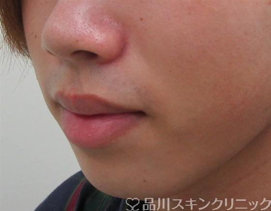 症例NO.30735のBEFORE写真