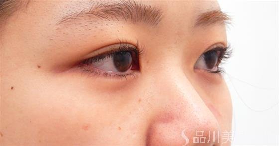 症例NO.52836のBEFORE写真