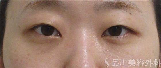 症例NO.55934のAFTER写真
