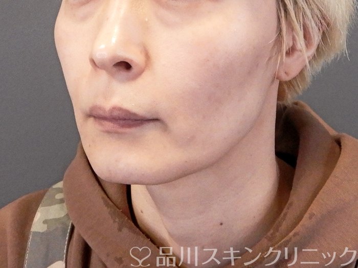 症例NO.63541のBEFORE写真
