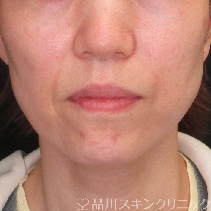 症例NO.73838のBEFORE写真