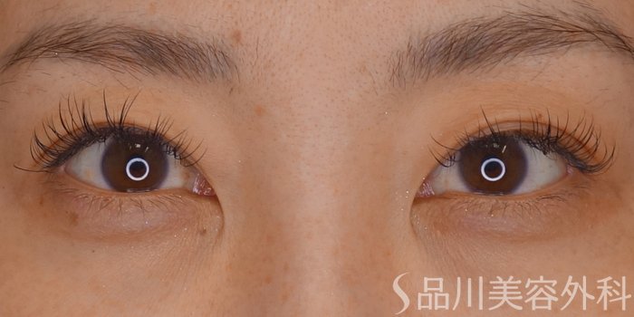 症例NO.69563のBEFORE写真