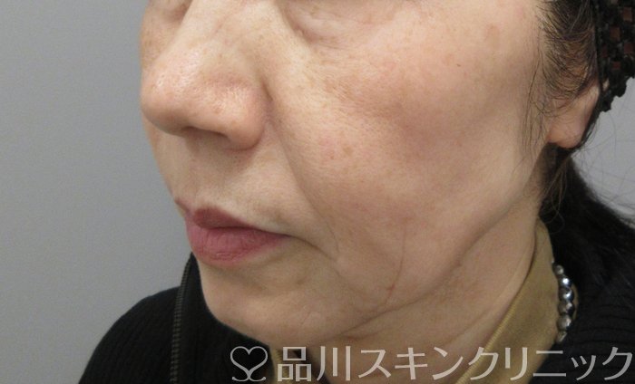 症例NO.70086のBEFORE写真