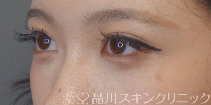 症例NO.74555のBEFORE写真